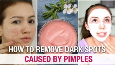 How to Remove Pimples and Dark Spots Quickly