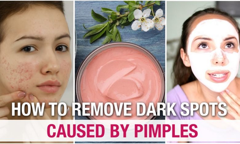 How to Remove Pimples and Dark Spots Quickly