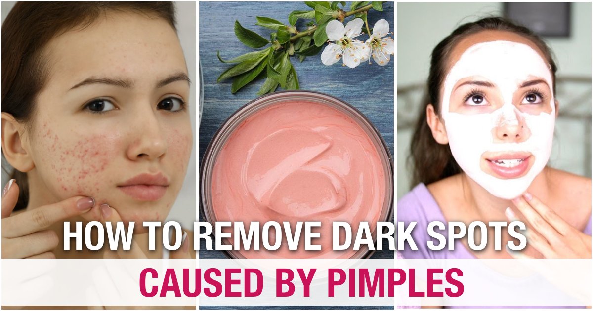 Best Tips On How To Remove Pimples And Dark Spots Quickly